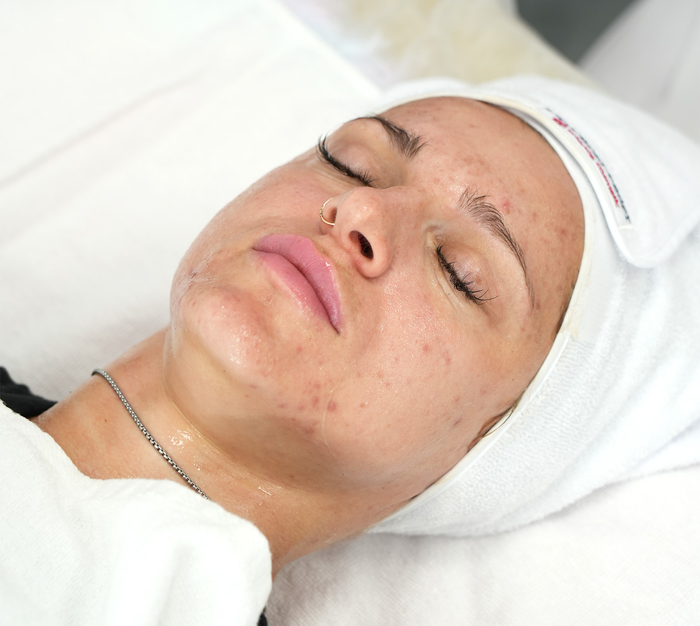 Acne Therapy